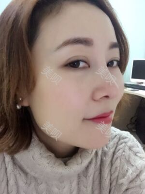 成都隆鼻整形整真實(shí)恢復(fù)圖片，終于有了韓式小翹鼻