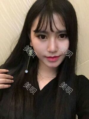 線D隆鼻恢復(fù)過(guò)程圖片，真實(shí)案例照片