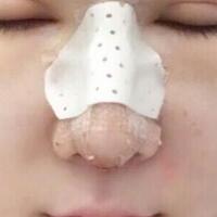 隆鼻失敗修復(fù)后恢復(fù)圖分享，鼻子修復(fù)價格9800元