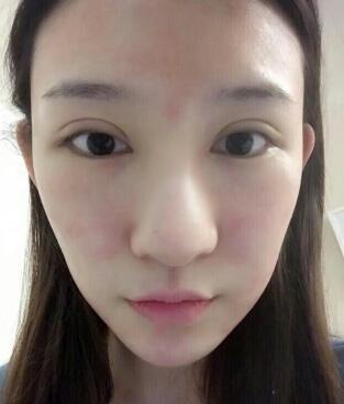 隆鼻失敗修復(fù)后恢復(fù)圖分享，鼻子修復(fù)價格9800元