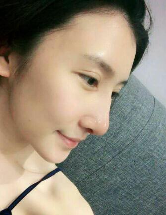 隆鼻失敗修復(fù)后恢復(fù)圖分享，鼻子修復(fù)價格9800元