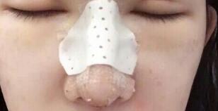 隆鼻失敗修復(fù)后恢復(fù)圖分享，鼻子修復(fù)價格9800元