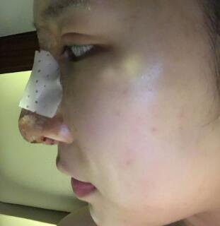 隆鼻失敗修復(fù)后恢復(fù)圖分享，鼻子修復(fù)價格9800元
