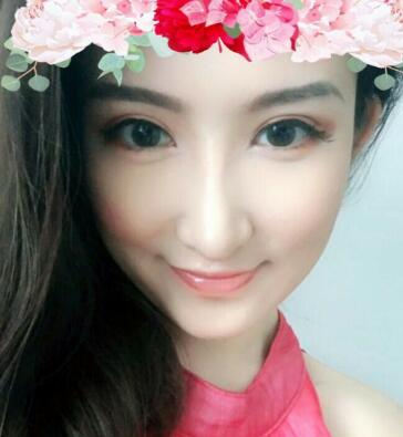 隆鼻失敗修復(fù)后恢復(fù)圖分享，鼻子修復(fù)價格9800元