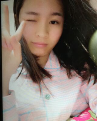 激光祛痘三次對(duì)比圖，痘痘全消除了