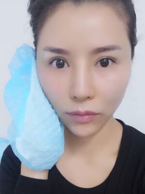 臉部埋埋蛋白線.提升果圖，真實經(jīng)歷分享