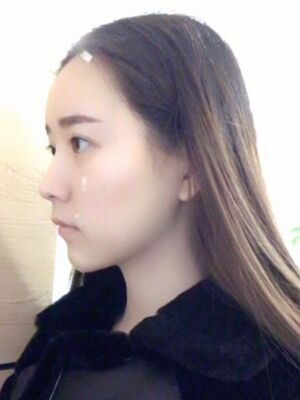 自體脂肪詳細部填充日記，恢復(fù)過程分享