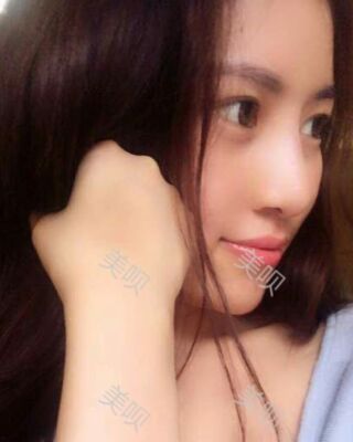 福州愛美爾假體隆鼻失敗后成功修復(fù)果圖