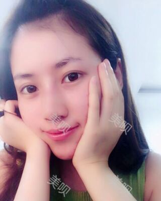 福州愛美爾假體隆鼻失敗后成功修復(fù)果圖