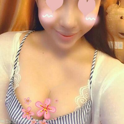 自體脂肪豐胸對比照片，福州愛美爾張勝利做的