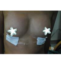 自體脂肪移植隆胸果圖分享，吸脂隆胸價格18800元