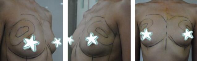 自體脂肪移植隆胸果圖分享，吸脂隆胸價格18800元