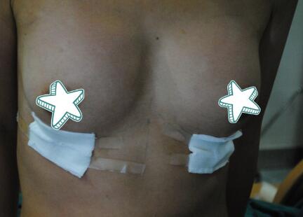 自體脂肪移植隆胸果圖分享，吸脂隆胸價格18800元