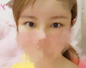 開內(nèi)眼角割雙眼皮恢復(fù)全過程和圖片分享，雙眼皮多項(xiàng)整形整形