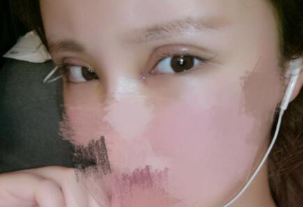 開內(nèi)眼角割雙眼皮恢復(fù)全過程和圖片分享，雙眼皮多項(xiàng)整形整形