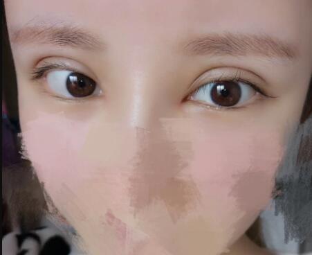 開內(nèi)眼角割雙眼皮恢復(fù)全過程和圖片分享，雙眼皮多項(xiàng)整形整形