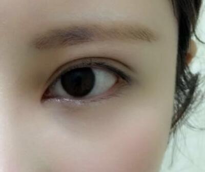 開內(nèi)眼角割雙眼皮恢復(fù)全過程和圖片分享，雙眼皮多項(xiàng)整形整形