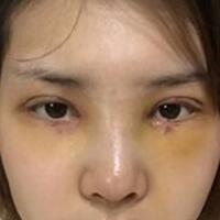 做了割雙眼皮和開內(nèi)眼角雙眼皮多項(xiàng)整形整形手術(shù)，恢復(fù)圖片日志分享