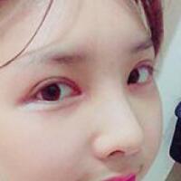 做了割雙眼皮和開內(nèi)眼角雙眼皮多項(xiàng)整形整形手術(shù)，恢復(fù)圖片日志分享