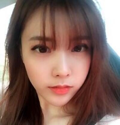 做了割雙眼皮和開內(nèi)眼角雙眼皮多項(xiàng)整形整形手術(shù)，恢復(fù)圖片日志分享