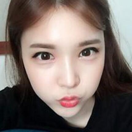 做了割雙眼皮和開內(nèi)眼角雙眼皮多項(xiàng)整形整形手術(shù)，恢復(fù)圖片日志分享