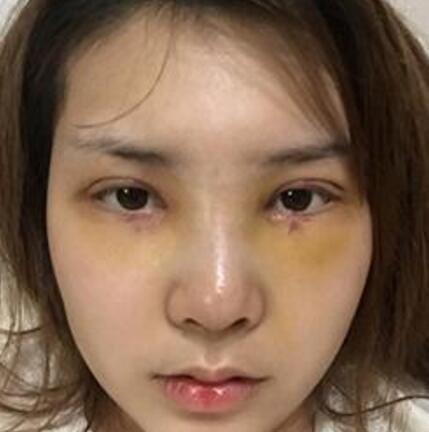 做了割雙眼皮和開內(nèi)眼角雙眼皮多項(xiàng)整形整形手術(shù)，恢復(fù)圖片日志分享