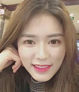 廣州凱美達皮膚美容激光祛斑前后對比