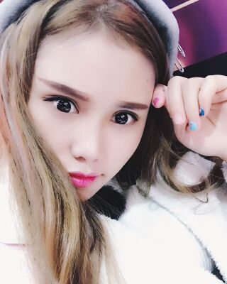 雙眼皮失敗修復果圖，福州愛美爾王召克做的