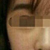 在濟(jì)南吉芙醫(yī)院做的玻尿酸填充淚溝，填充淚溝圖片分享