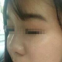 在濟(jì)南吉芙醫(yī)院做的玻尿酸填充淚溝，填充淚溝圖片分享