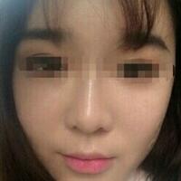 在濟(jì)南吉芙醫(yī)院做的玻尿酸填充淚溝，填充淚溝圖片分享