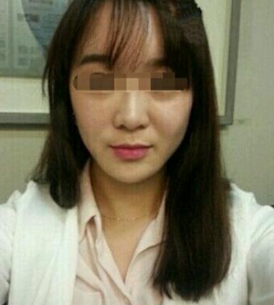 在濟南吉芙醫(yī)院做的玻尿酸填充淚溝，填充淚溝圖片分享