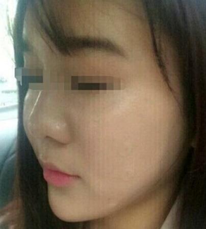 在濟南吉芙醫(yī)院做的玻尿酸填充淚溝，填充淚溝圖片分享