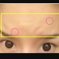 注射瘦臉去抬頭紋果不錯(cuò)——濟(jì)南吉芙美容整形醫(yī)院