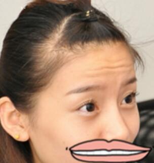 注射瘦臉去抬頭紋果不錯——濟南吉芙美容整形醫(yī)院