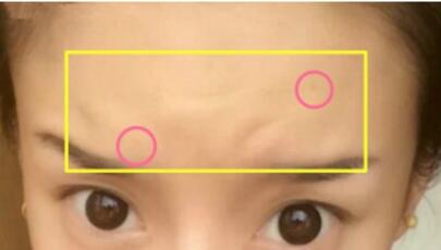 注射瘦臉去抬頭紋果不錯——濟南吉芙美容整形醫(yī)院