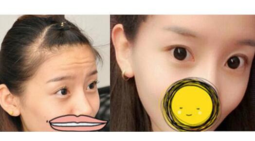 注射瘦臉去抬頭紋果不錯——濟南吉芙美容整形醫(yī)院