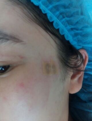 激光去咖啡斑恢復(fù)過程，福州美貝爾真實(shí)案例