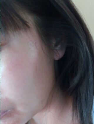 激光去咖啡斑恢復(fù)過程，福州美貝爾真實(shí)案例