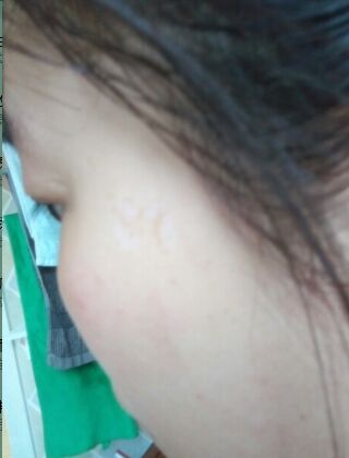 激光去咖啡斑恢復(fù)過程，福州美貝爾真實(shí)案例