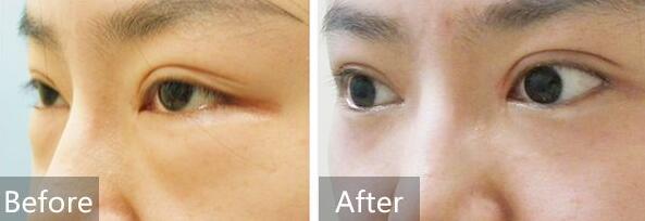 去眼袋前后對比圖，去眼袋價格