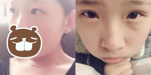 割雙眼皮前后對比圖，眼睛整形價格