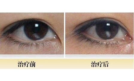 開內(nèi)眼角前后對比圖，眼睛整形價格