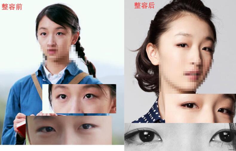 周冬雨割單眼皮前后對比圖，單眼皮割雙眼皮價(jià)格和果圖