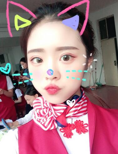 上海澳雅鄺勇韓式全切雙眼皮恢復過程圖