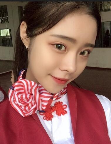 上海澳雅鄺勇韓式全切雙眼皮恢復過程圖