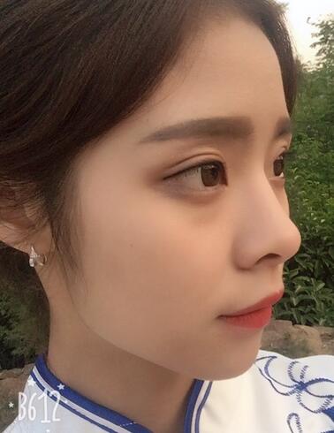 上海澳雅鄺勇韓式全切雙眼皮恢復過程圖