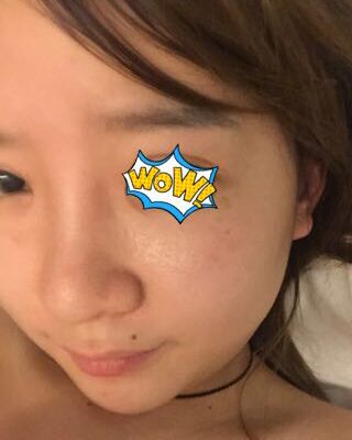 第(一)次激光去雀斑果圖，貴陽美萊劉紅武做的