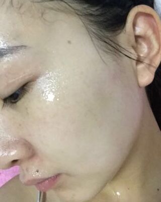 第(一)次激光去雀斑果圖，貴陽美萊劉紅武做的