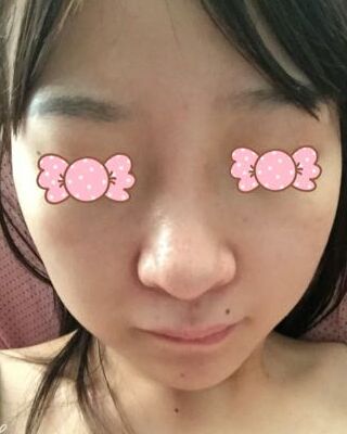 第(一)次激光去雀斑果圖，貴陽美萊劉紅武做的